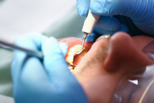 Best Emergency Dental Extractions in San Carlos, TX