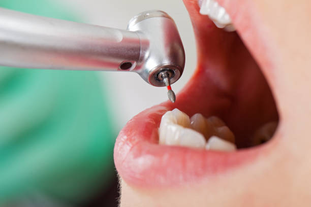 Best Emergency Dentist for Knocked-Out Tooth in San Carlos, TX